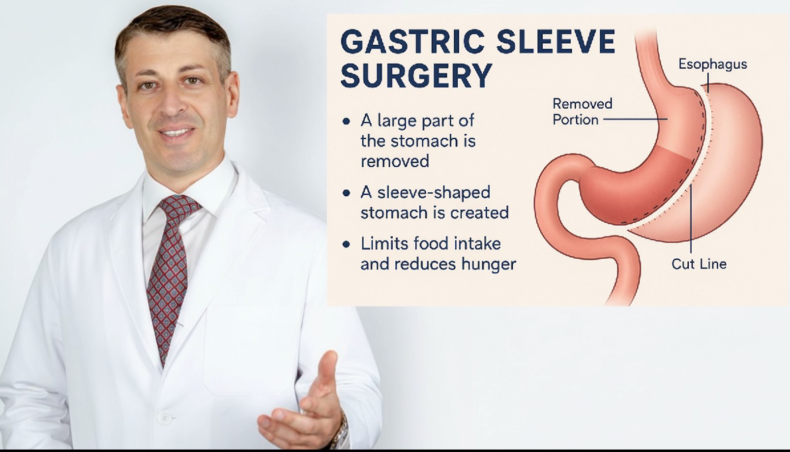 Sleeve Gastrectomy Surgery in Brooklyn, NY — Dr. Sergey Terushkin, MD, FACS at Goal BMI Clinic