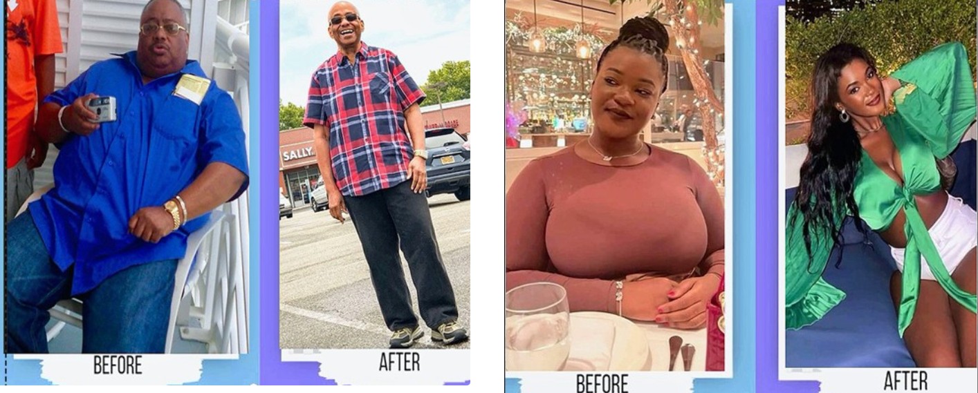 before and after gastric sleeve surgery Brooklyn, Dr, Terushkin