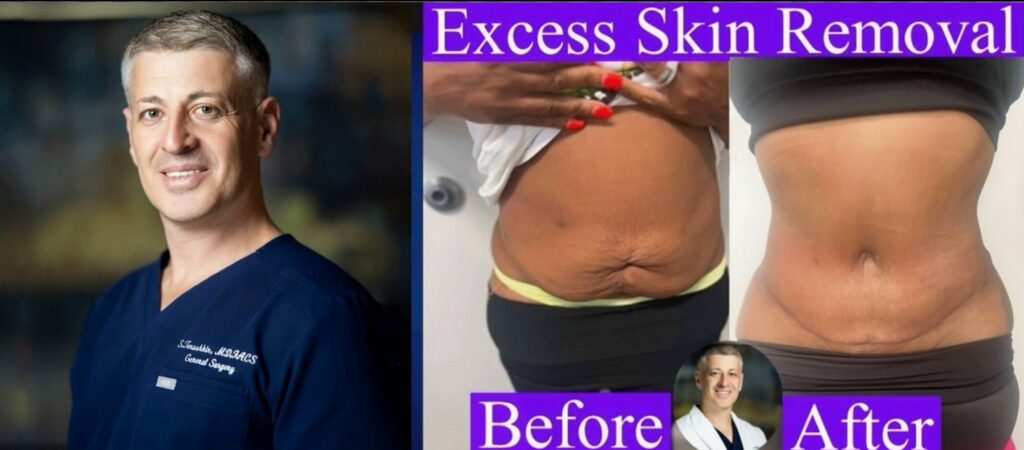 excess skin removal after weight loss brooklyn, dr, Terushkin