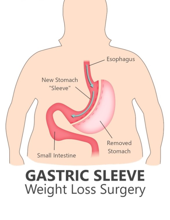 gastric sleeve surgery Brooklyn NY