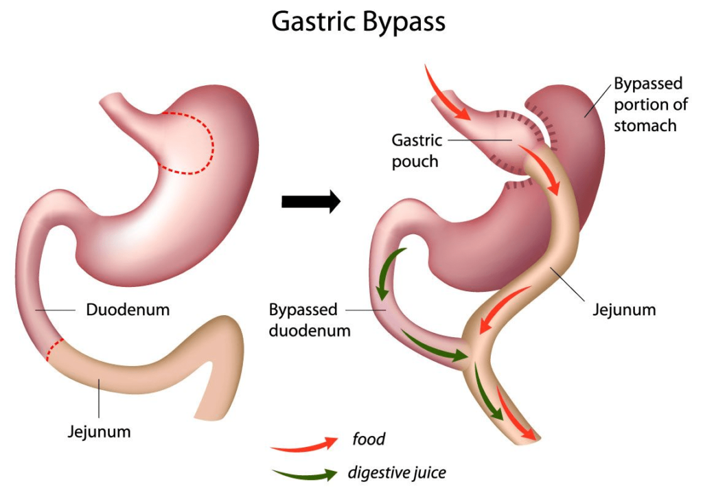 Gastric Bypass, Brooklyn NY