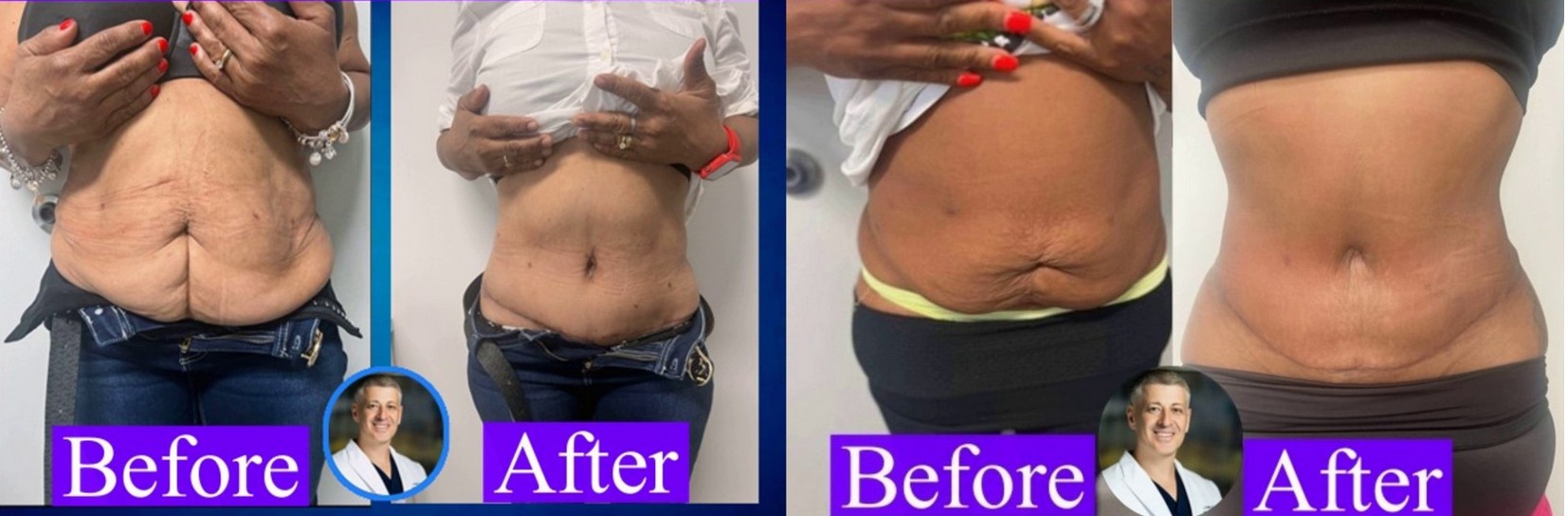 Excess Skin Removal Before & After Results