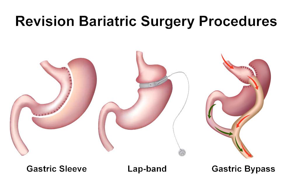 Revisional Bariatric Surgery In Nyc Cost Insurance Self Pay Options Gastric Sleeve 7060