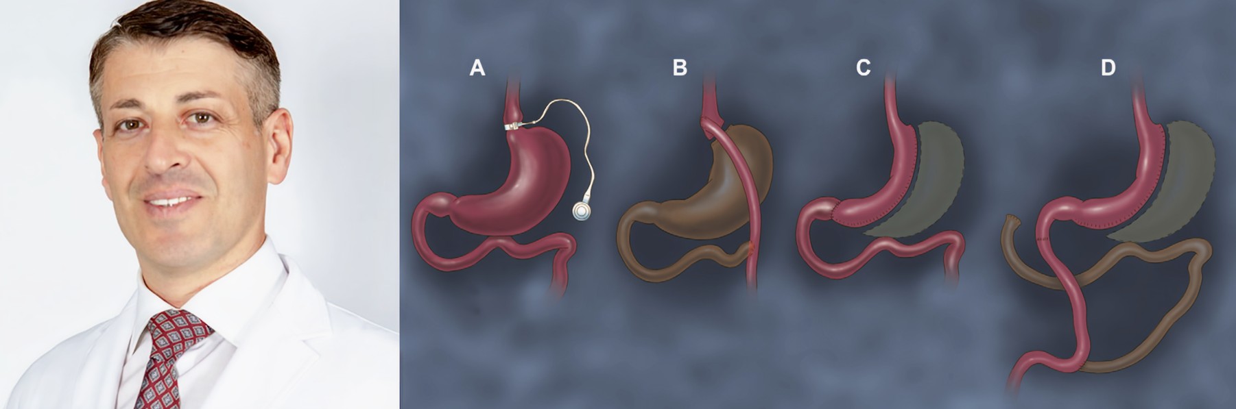 Types of Revisional Bariatric Surgery