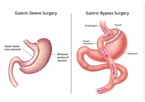 Comparing Two Popular Revisional Bariatric Surgeries: Gastric Sleeve vs. Gastric Bypass