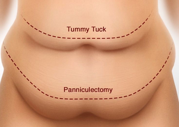 Tummy Tuck vs Panniculectomy - Halifax, NS - Prince Edward Island