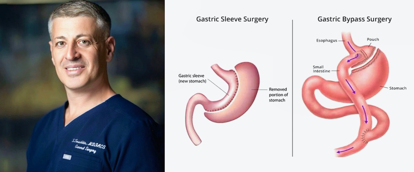 revisional bariatric surgery - Brooklyn Dr. Terushkin