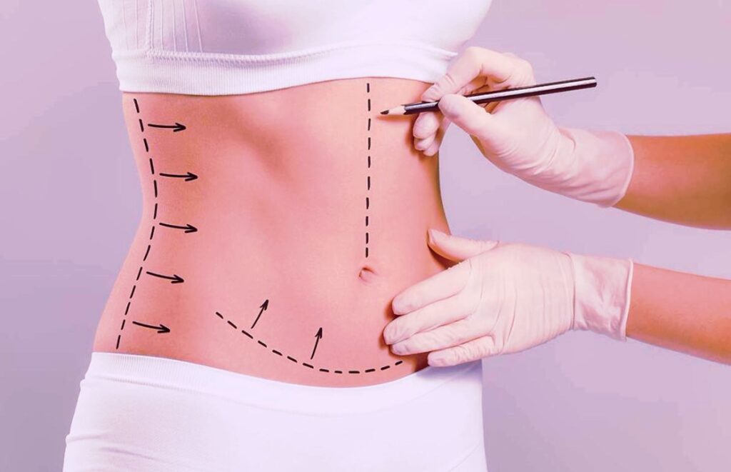 Tummy Tuck after Weight Loss