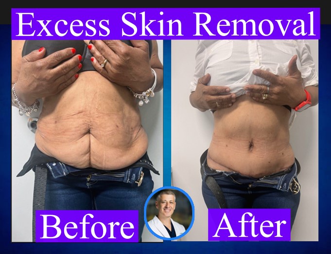 Excess Skin Removal Before & After Weight Loss at Our Clinic