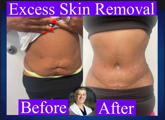 Before & After Excess Skin Removal After Weight Loss Top Dr. Sergey Terushkin