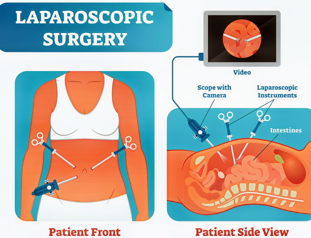 Labeled medical illustration of laparoscopic surgery showing front and side views of a patient torso, surgical instruments, camera scope, and internal abdominal anatomy, educational infographic in landscape format